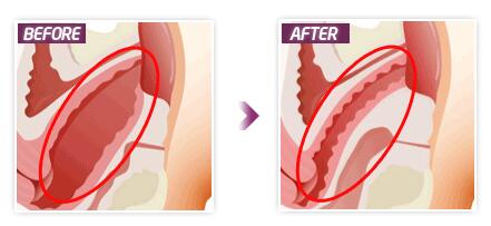 丽姿医院激光阴道紧缩术卡通对比图
