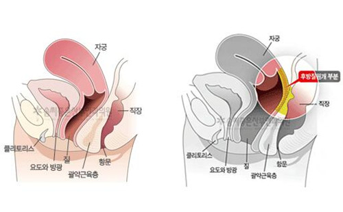 阴道紧缩示意图