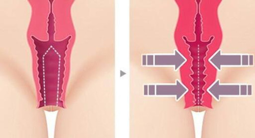 阴道紧缩术前后对比示意图