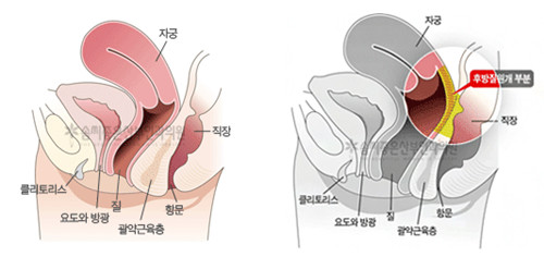 好手艺私密整形医院后方膣圆盖术示意图