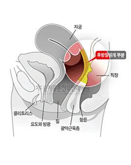 阴道紧缩之：后方膣圆盖术