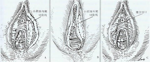 小阴唇手术过程