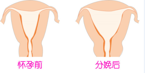 后方膣圆盖手术