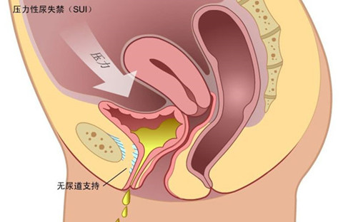 子宫下垂引起尿失禁