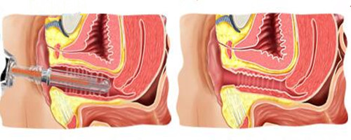 激光阴道紧缩术前后对比