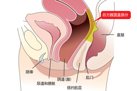 后方膣圆盖术缩术部位介绍