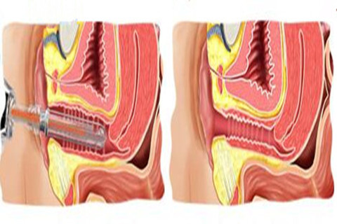 激光阴道紧缩术示意图
