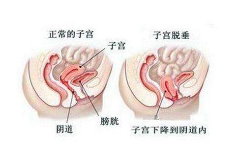 正常子宫与子宫下垂的对比