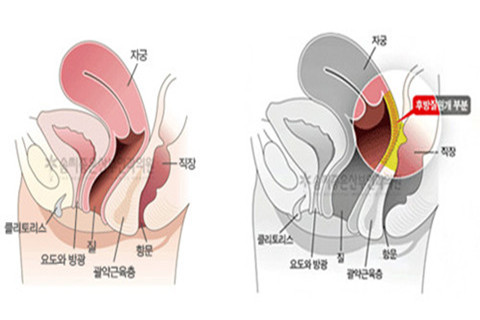 后方膣圆盖术示意图