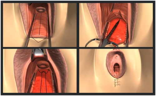 韩式无痕缩阴术