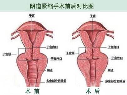 缩阴手术效果能维持多久