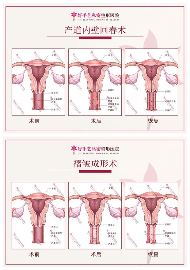 做缩阴手术时为什么要搭配褶皱成形术？