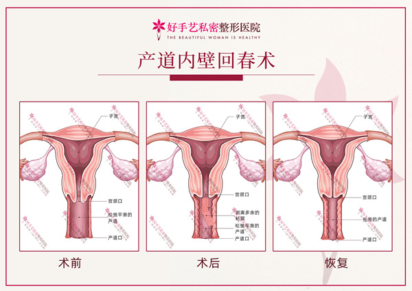 产后缩阴