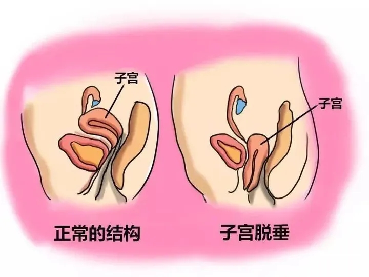 盆底肌对于子宫下垂的重要性