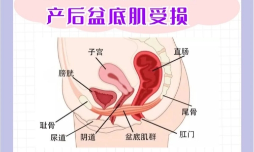 产后盆底肌受损.jpg