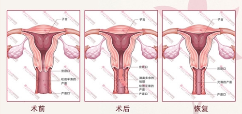 好手艺妇科缩阴后