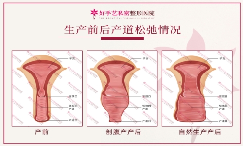 好手艺妇科女性产后阴道情况