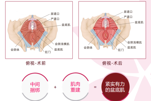 盆底肌修复