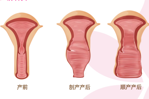 产后松弛干涩