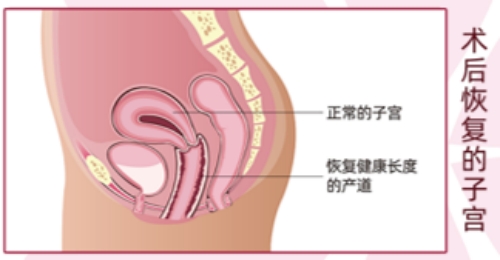 术后恢复的子宫侧面图