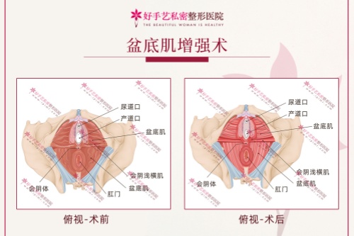 后方膣圆盖术的盆底肌增强术