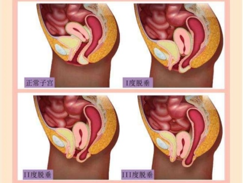 子宫下垂程度