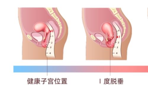 轻度子宫下垂