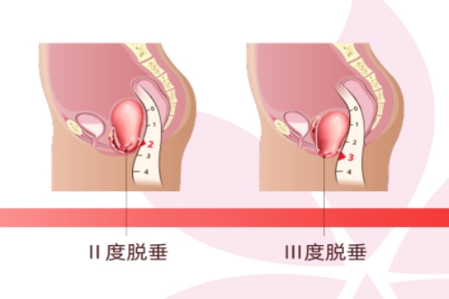 二度，三度子宫下垂