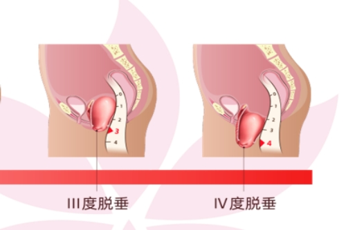 重度子宫下垂