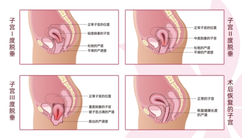 子宫下垂变化以及术后