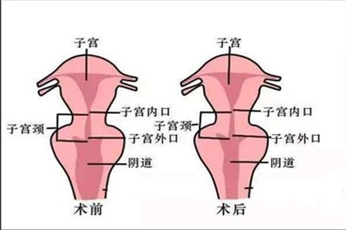 私密手术的术前术后差别