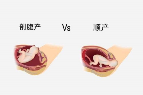 顺产和剖腹产