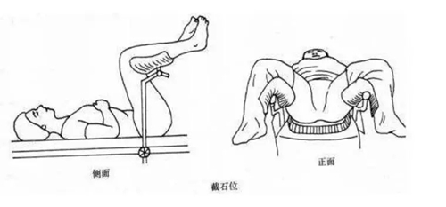 妇科检查常用截石位