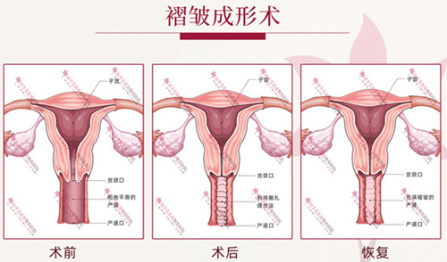 褶皱成形术