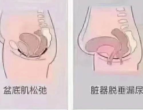 盆底肌漏尿.jpg