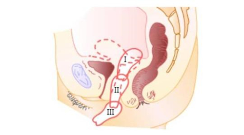 子宫下垂程度示意图