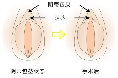 阴蒂包皮过长手术前后