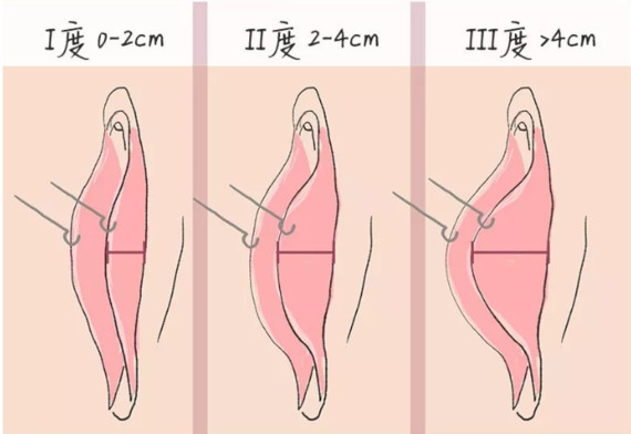 小阴唇肥大程度分级