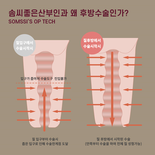 尹虎珠院长缩阴手术优势