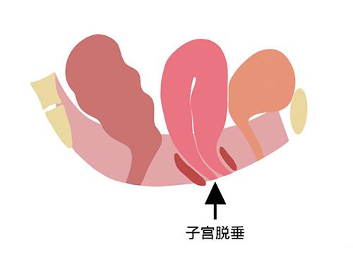 子宫下垂通常有什么症状