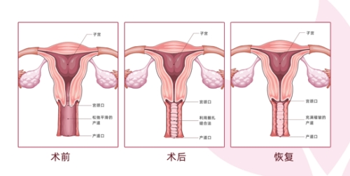 尹虎珠院长缩阴手术