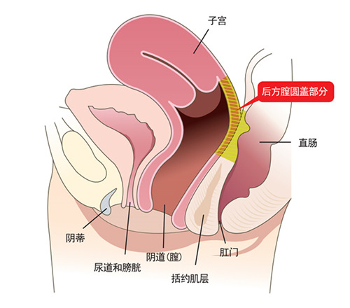 后方膣圆盖术