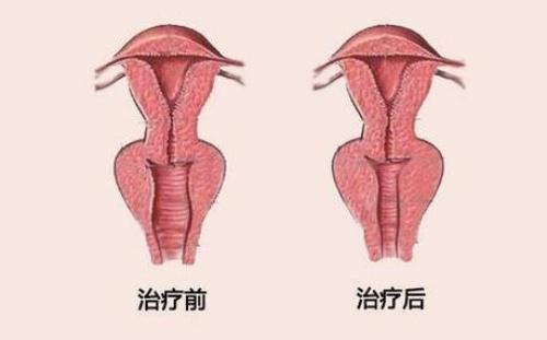 缩阴手术前后对比