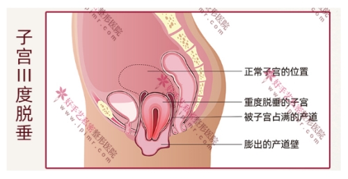 子宫下垂