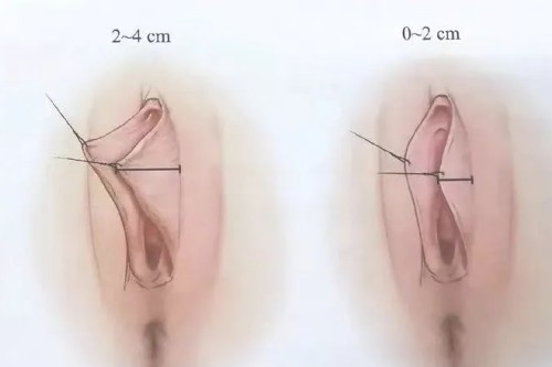 阴唇整形