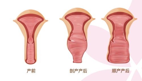 阴道松弛