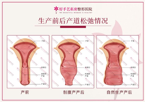 阴道紧缩术