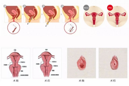 阴道紧缩术4.jpg